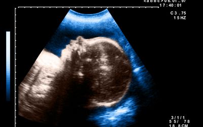 胎儿的超声生物测定＂width=