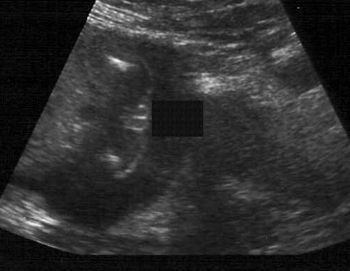 22周女婴的超声波检查