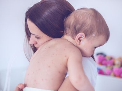 Mom holding baby with chicken pox