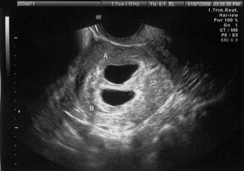 超声图像显示两个妊娠囊