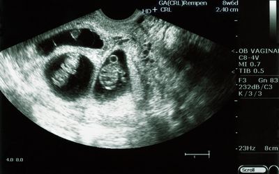 双胞胎怀孕华体会体育官方人口的超声波——是双胞胎!