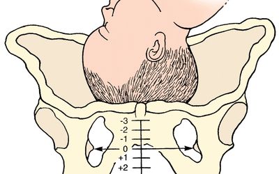 从骨盆骨上方的一侧显示婴儿头部的插图