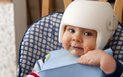 Cranial Remolding helmet worn for the treatment of plagiocephaly