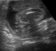 27 Week - Girl Ultrasound