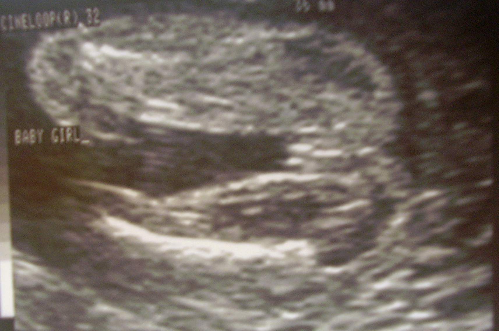 It's a girl! 17 Week Ultrasound