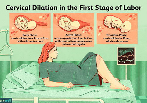 分娩第一阶段宫颈扩张的图示