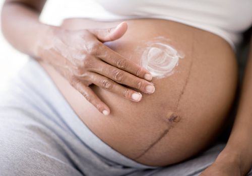 孕妇在妊娠纹上涂面霜