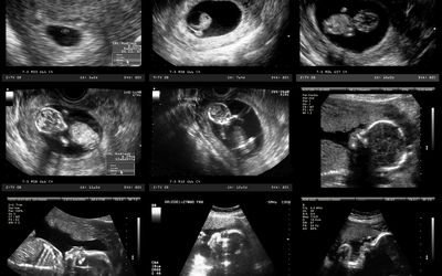 超声观察胎儿发育