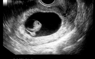 7周大胚胎的超声图像