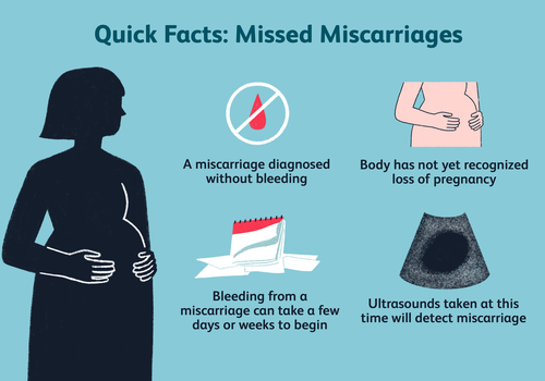 Quick facts about missed miscarriages