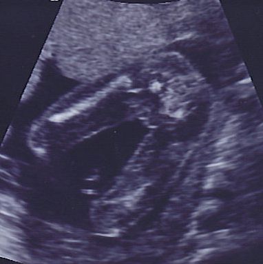 20 week girl ultrasound