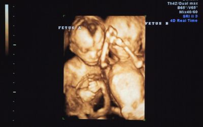 超声检查发华体会体育官方人口现双胞胎怀孕17周