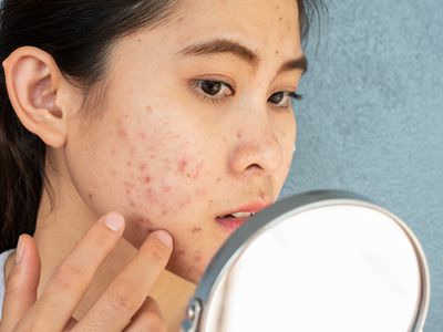 Woman looking at acne on face in mirror