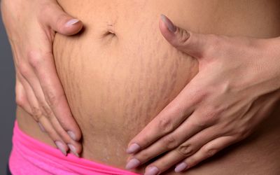 腹部有妊娠纹的女性的腹部