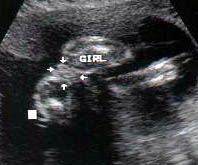 23周胎儿的超声波检查