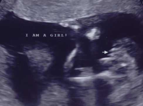 16周胎儿超声检查