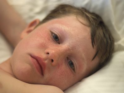 Boy with sunburned face