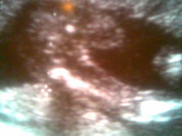 17 Week Baby Girl Ultrasound