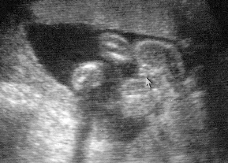 It's a girl at 20 weeks!