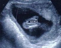 14 Week Ultrasound - It's a girl!