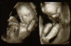 3D超声照片怀孕24周-超声照片