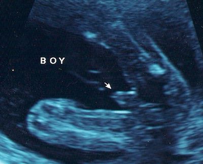 17周超声照片——是个男孩!——超声波照片