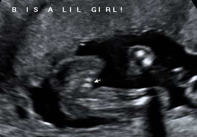 It's a girl! Twin B - 18 Week Ultrasound