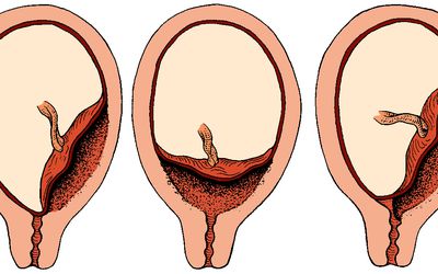 前置胎盘有三种类型。