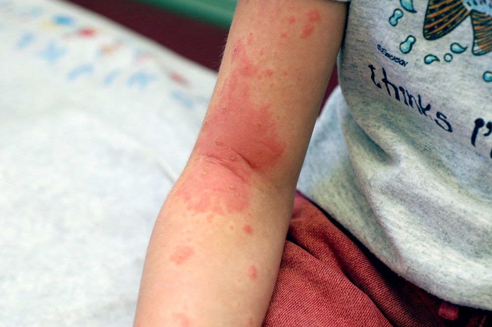 孩子胳膊上常见的毒葛疹子。