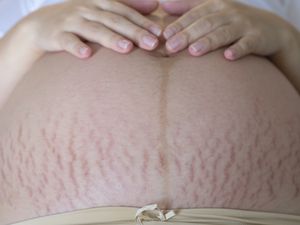 公关egnant stomach with stretch marks