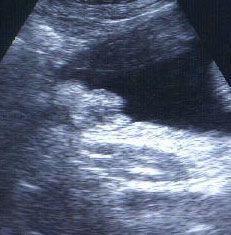 36 Week Girl Ultrasound