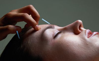 Picture of a woman receiving acupuncture treatment.