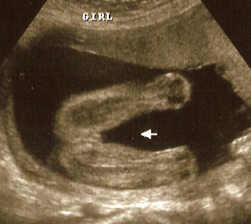 22 Week Baby Girl Ultrasound