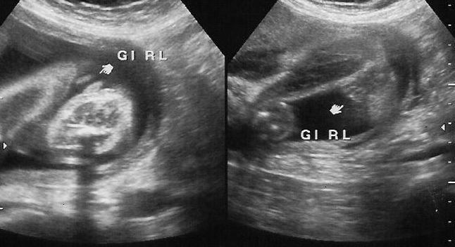 26 Ultrasound - It's a girl!