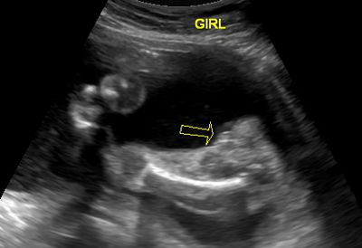 23 Week Ultrasound - It's a girl!