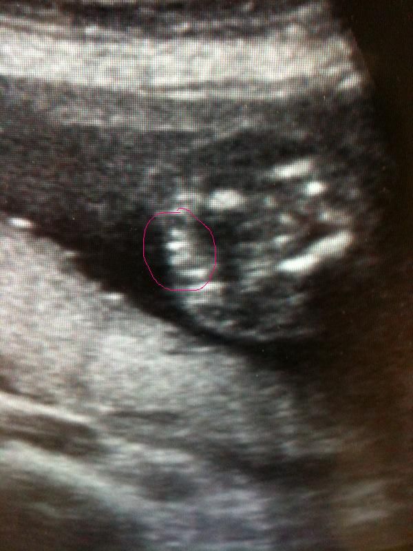 20 Week Ultrasound - It's a girl!