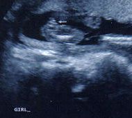 18 Week Ultrasound Baby Girl